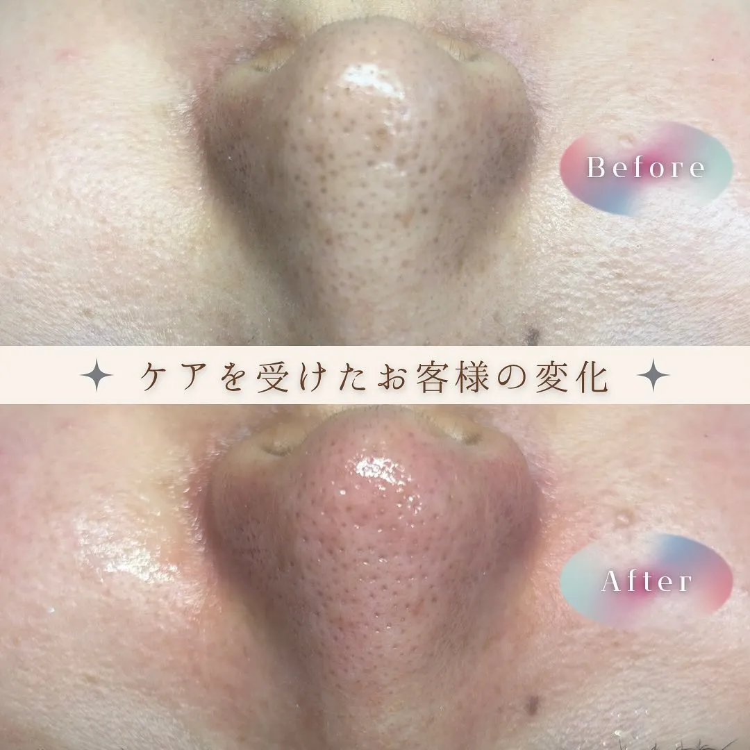 毛穴エクストラクション症例⭐️