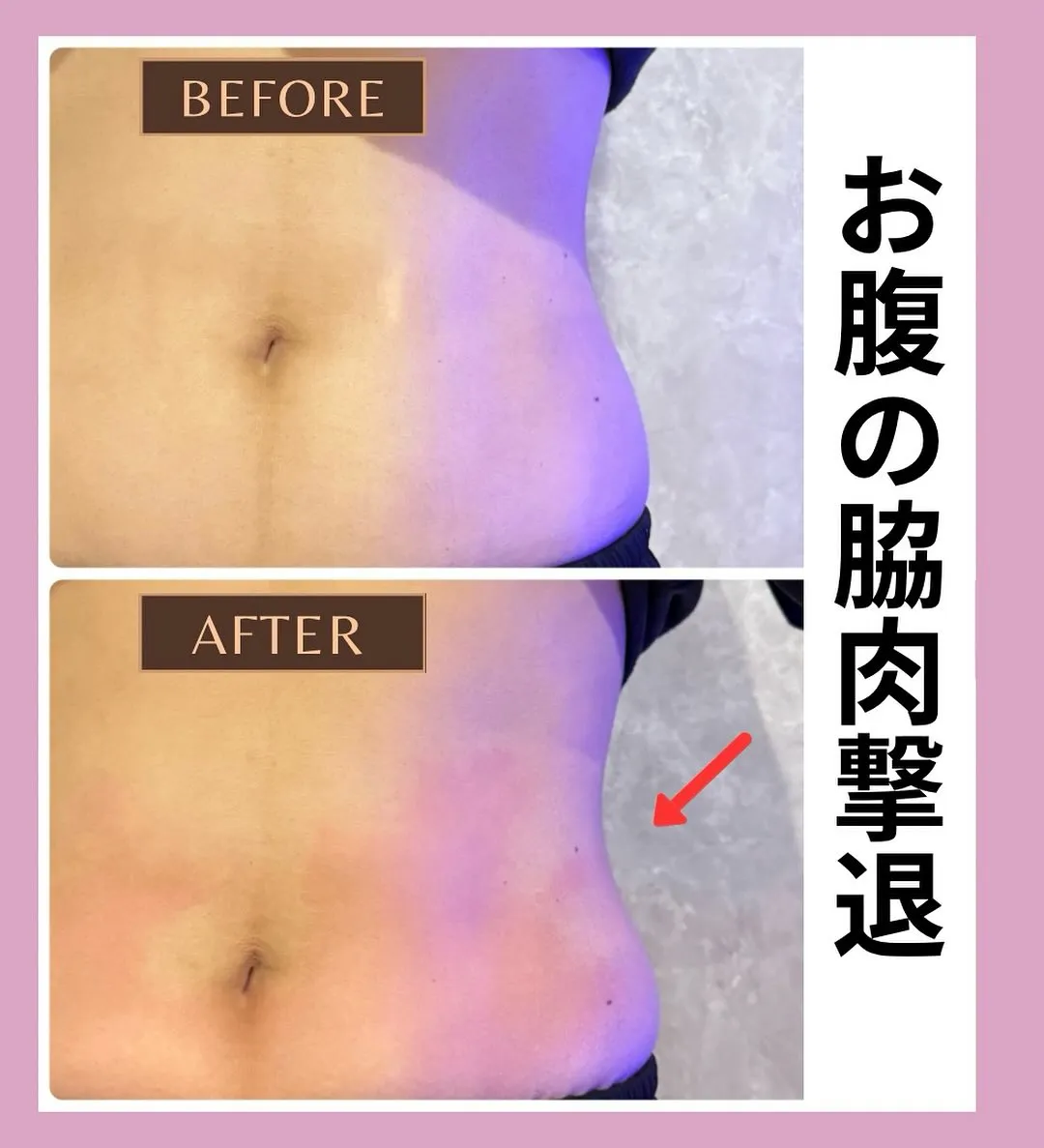 ✨エキスパートMAXボディ症例✨