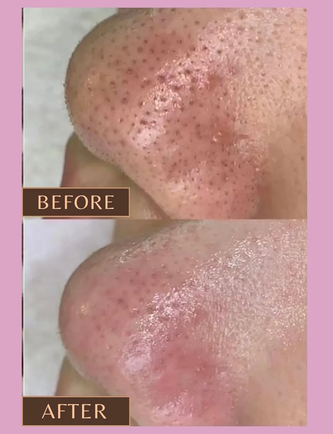 💎毛穴エクストラクション症例💎