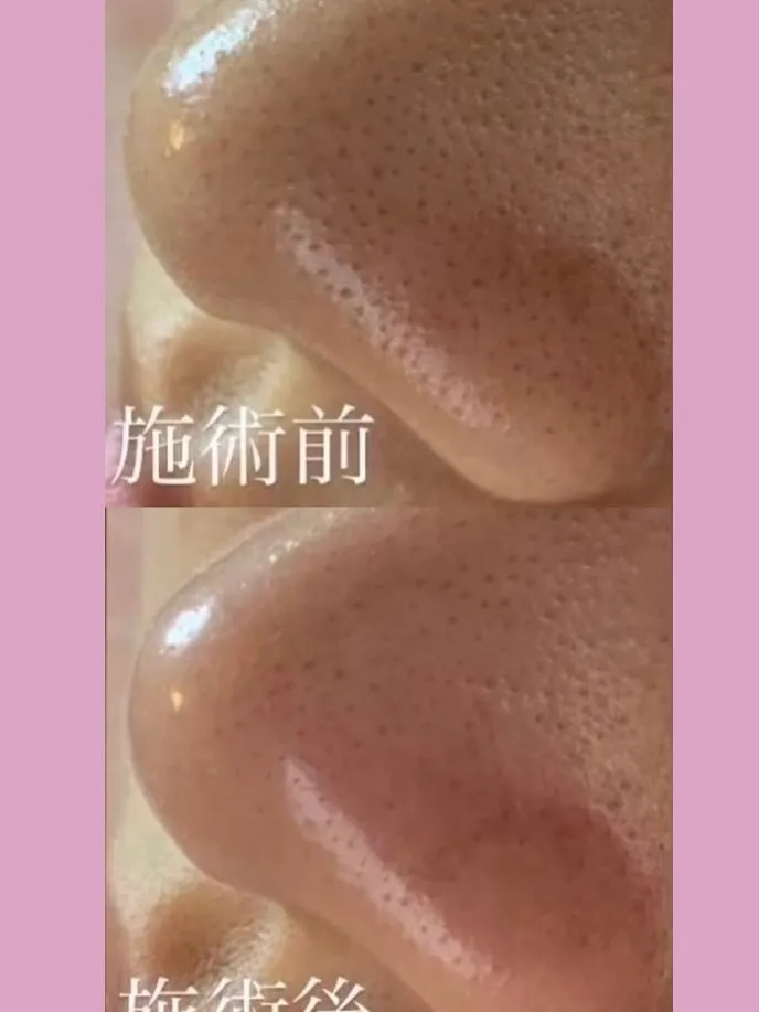 ＼黒ずみ毛穴には“ダブルケア”が鍵✨／