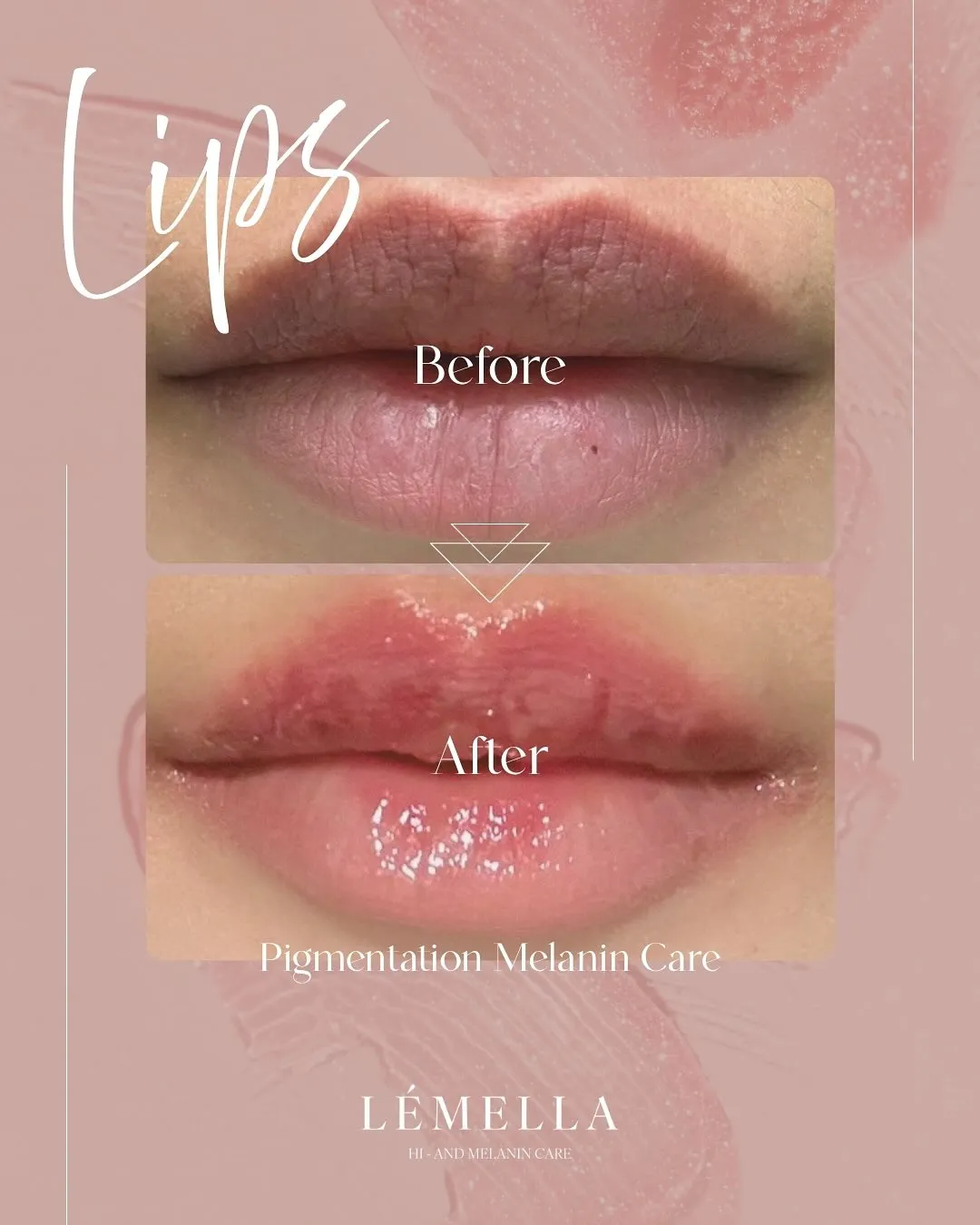 気になるルメラの施術の流れ💝