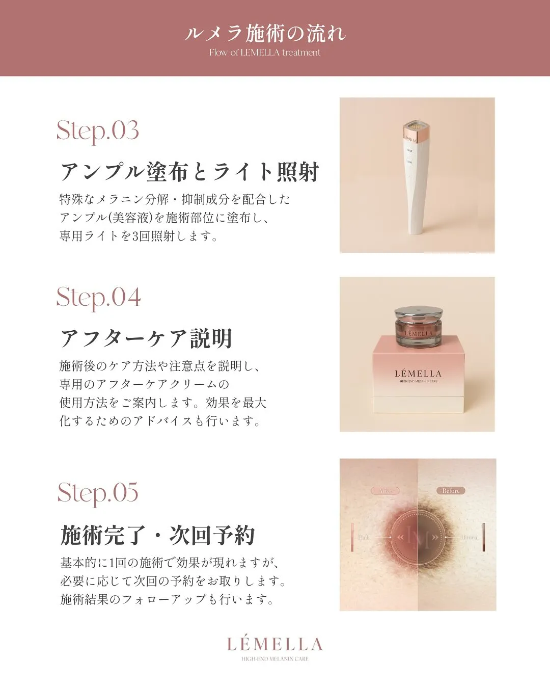 気になるルメラの施術の流れ💝