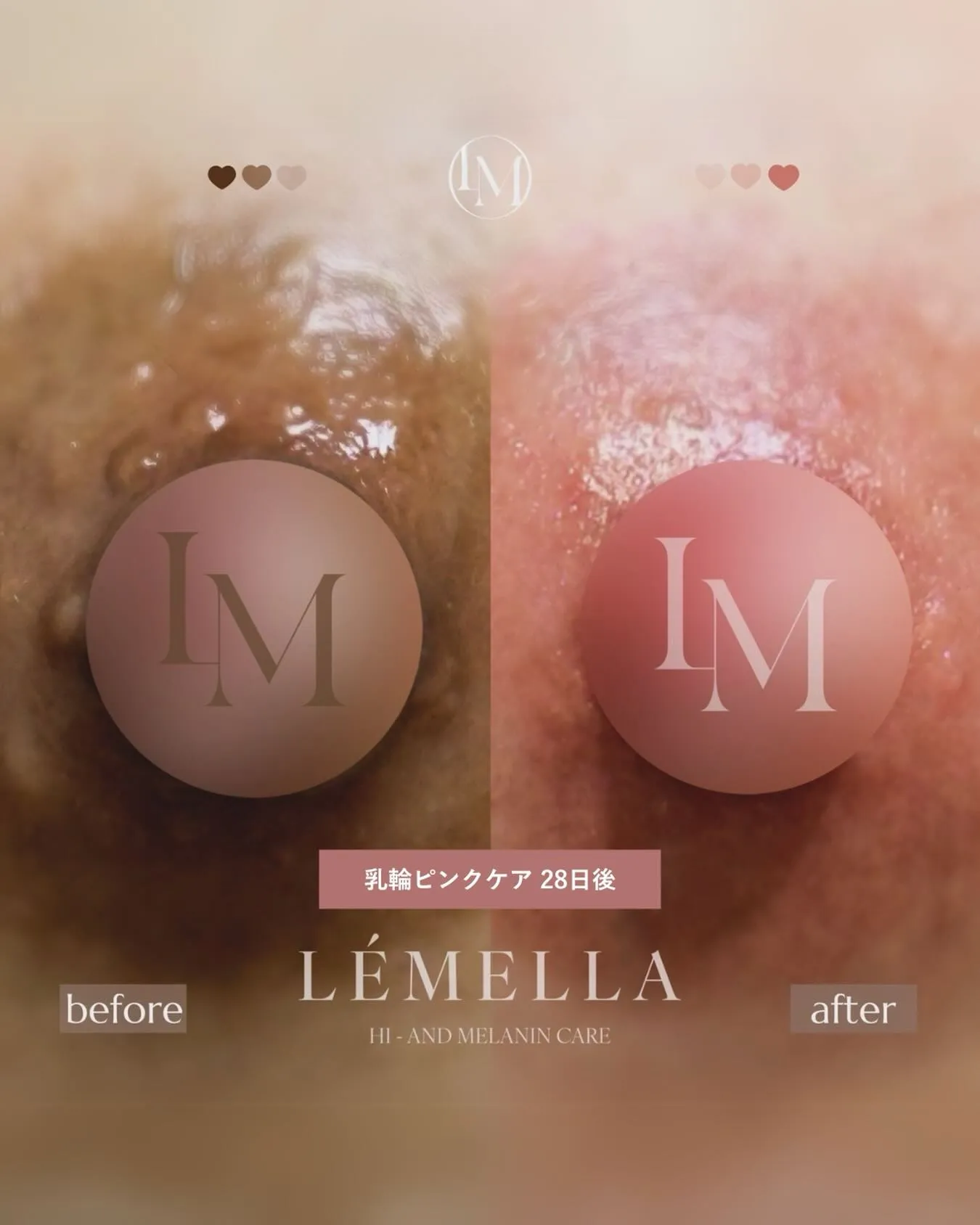 ＼ルメラ症例をご紹介🌿／