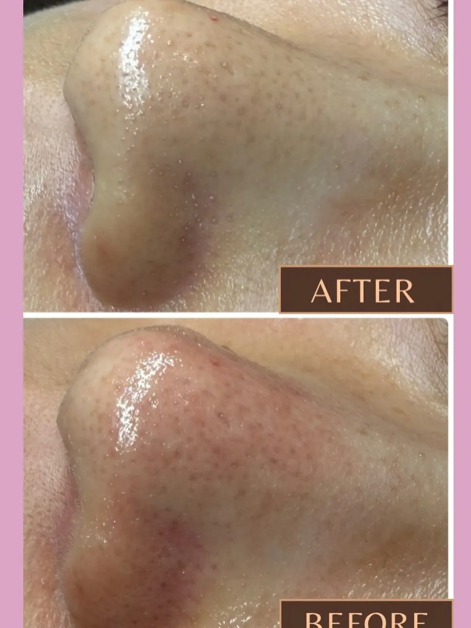 ＼毛穴エクストラクション症例✨／