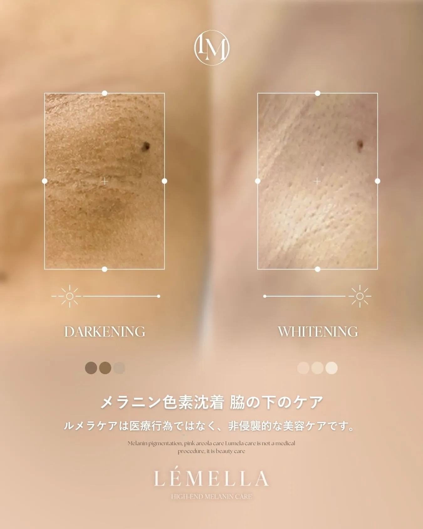 ✨ルメラ症例✨