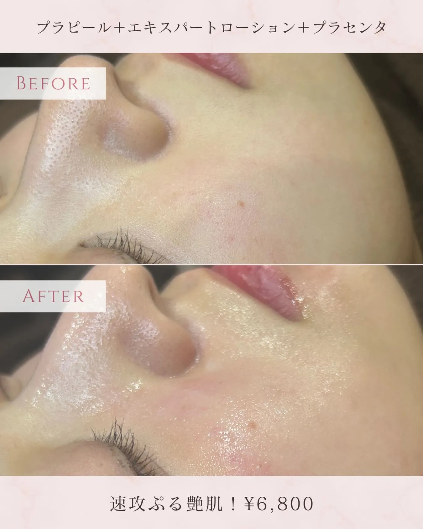 プラチナピール症例✨