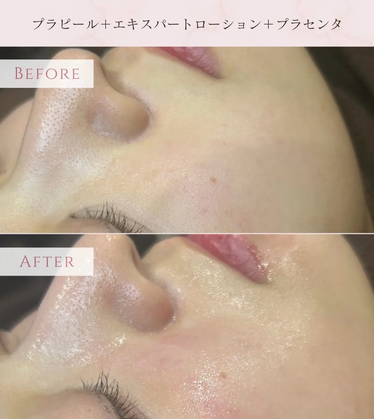 プラチナピール症例✨