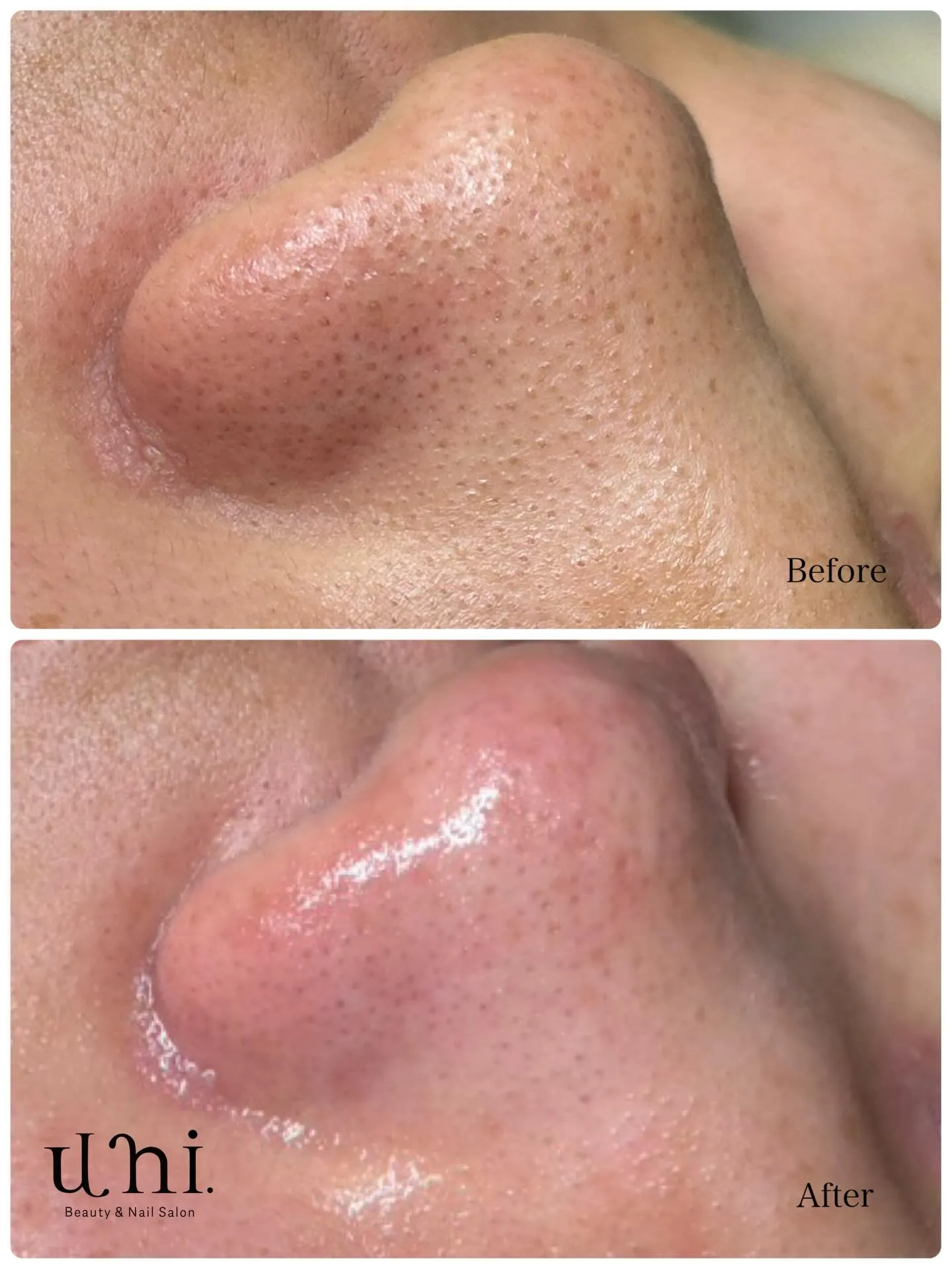 毛穴エクストラクション症例🍓