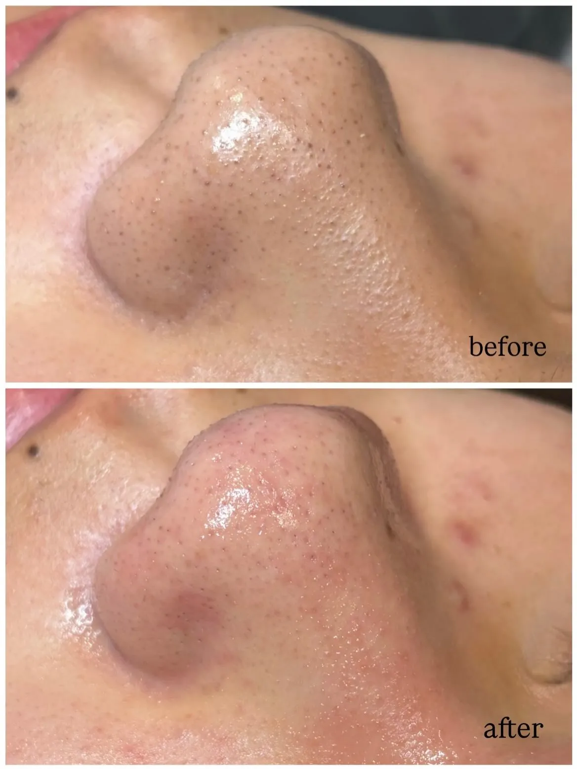 毛穴エクストラクション症例🍓