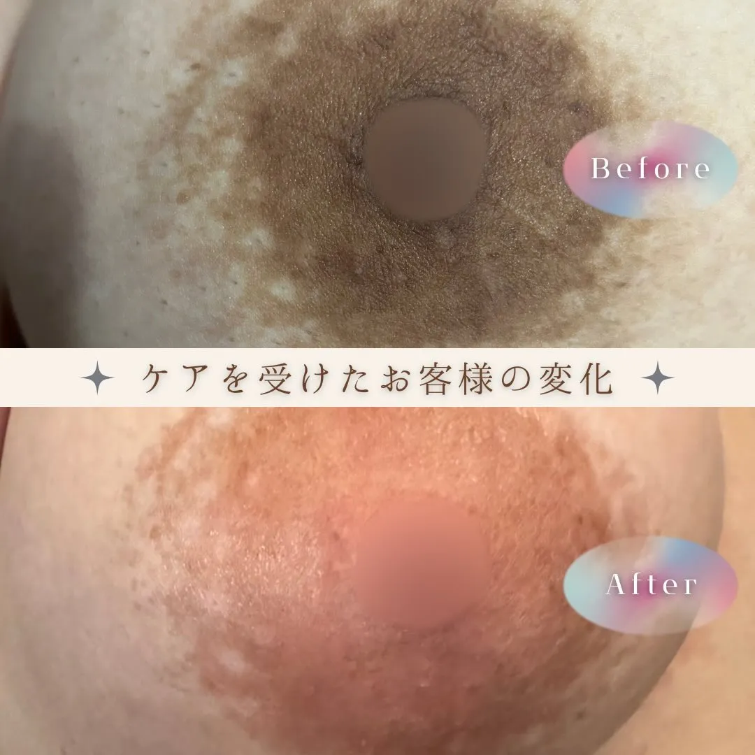 ルメラの症例をご紹介🎀🤍