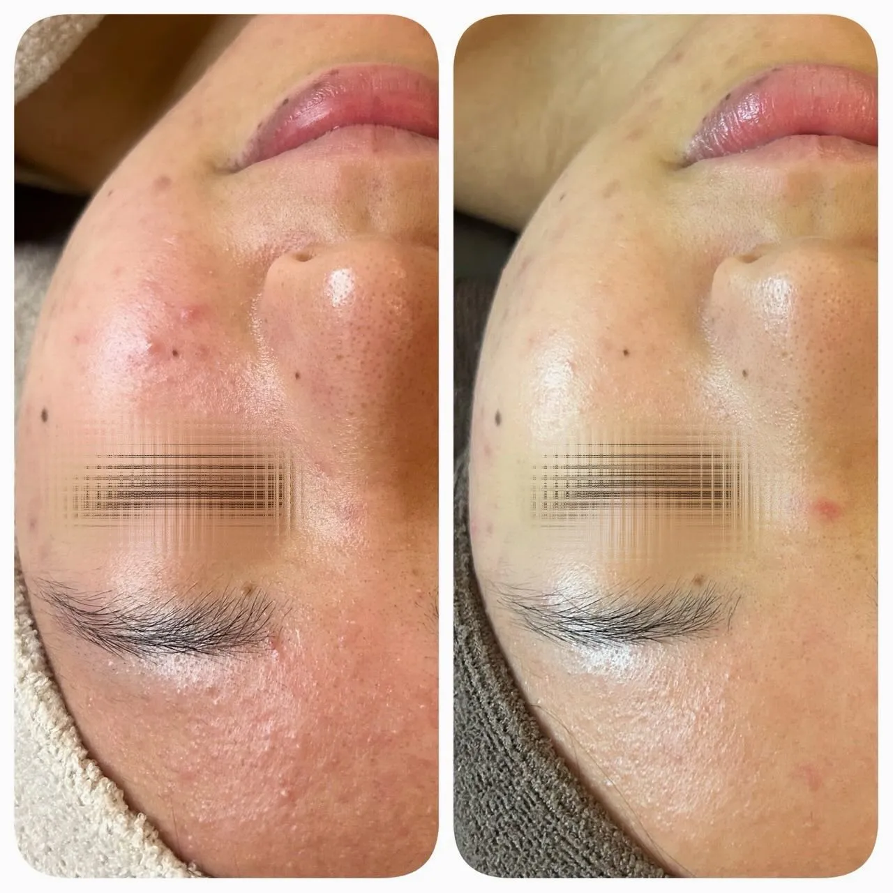 ショートカットピーリング症例🌿