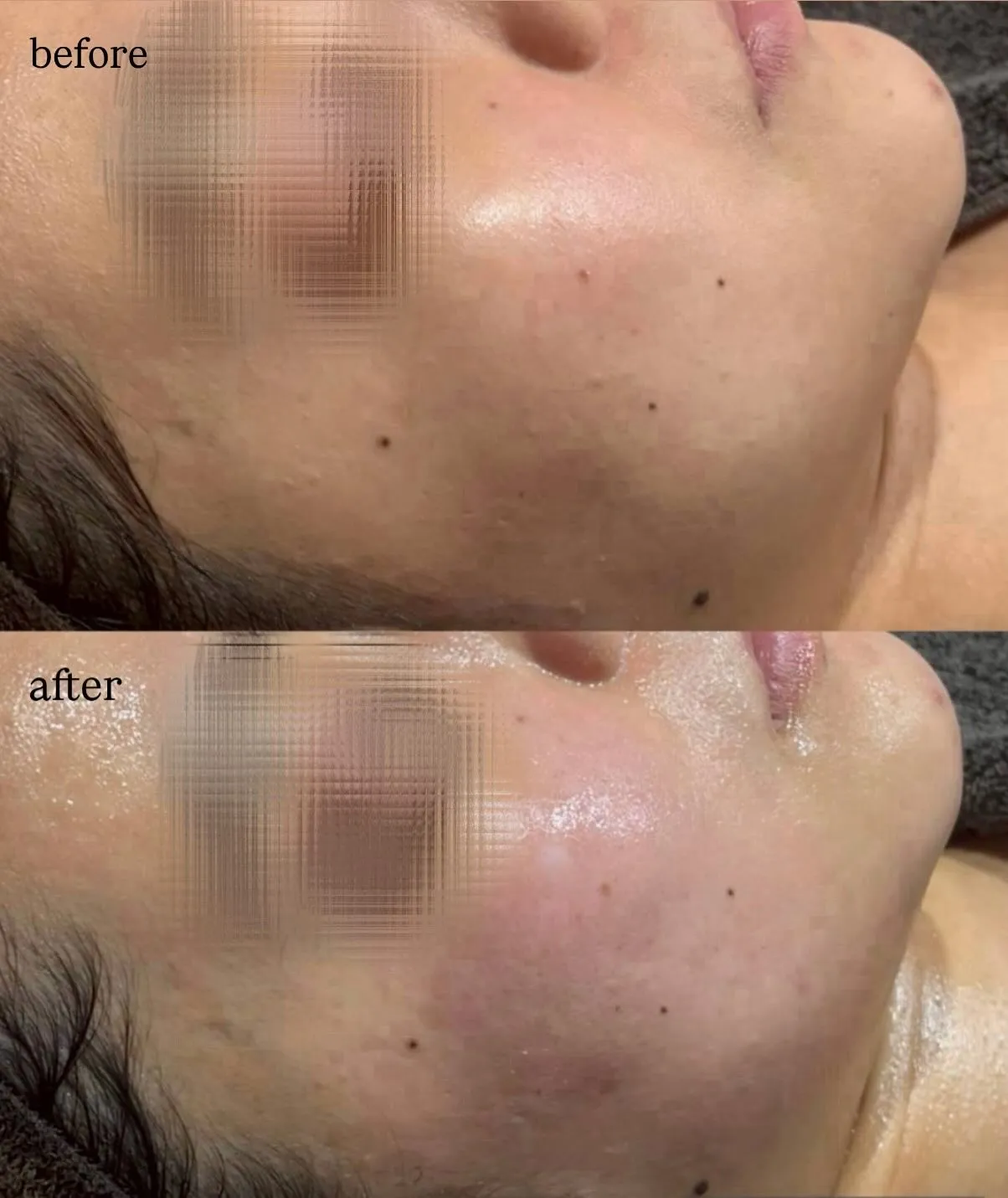 最近話題のスキンジェクションご存知ですか？👀✨