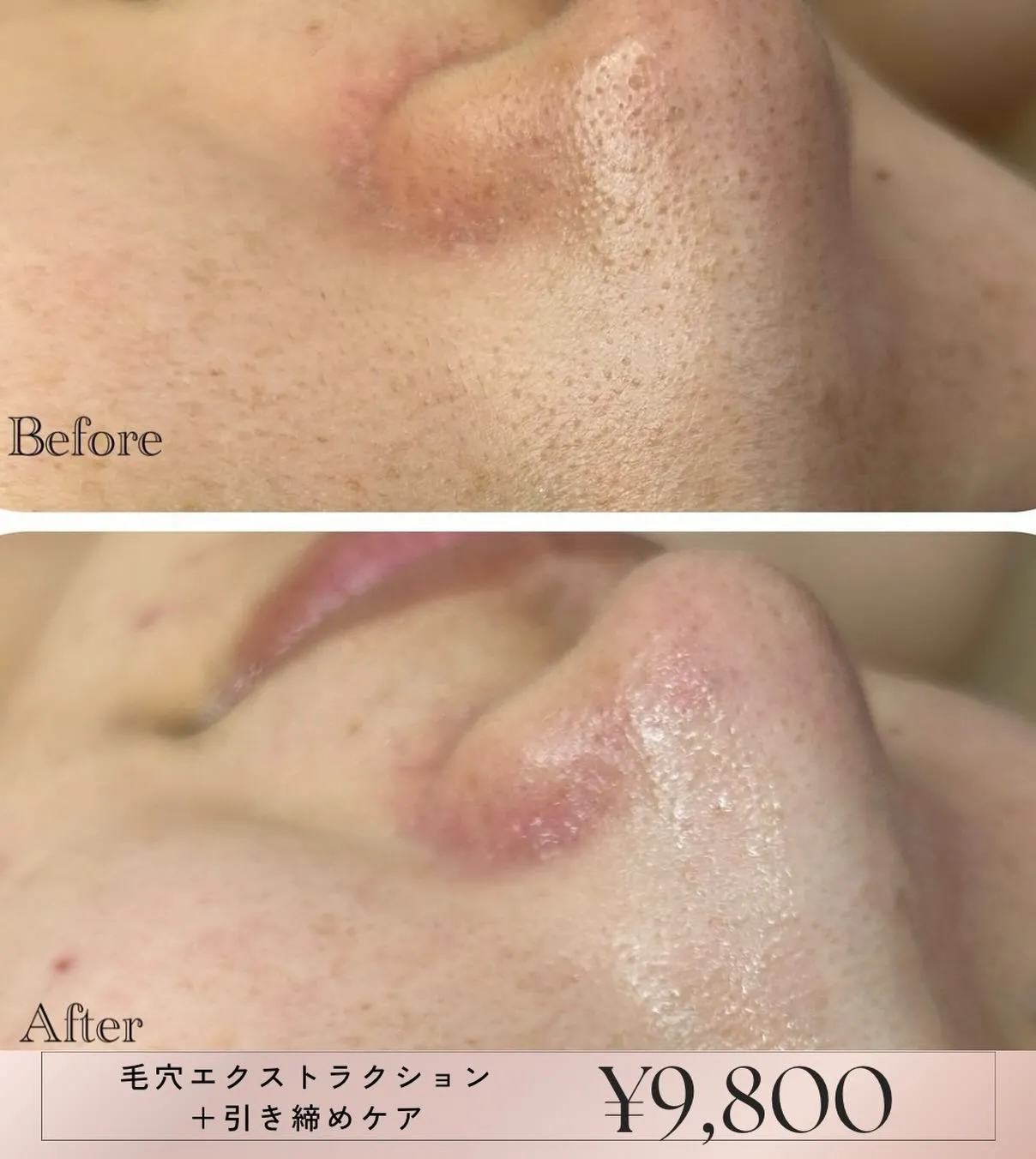 毛穴エクストラクションは