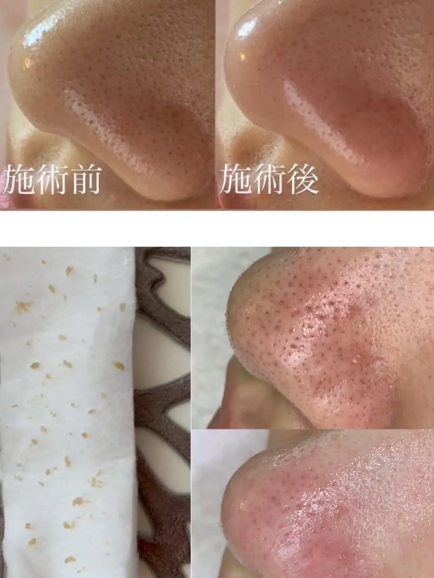 大人気毛穴エクストラクション🌱