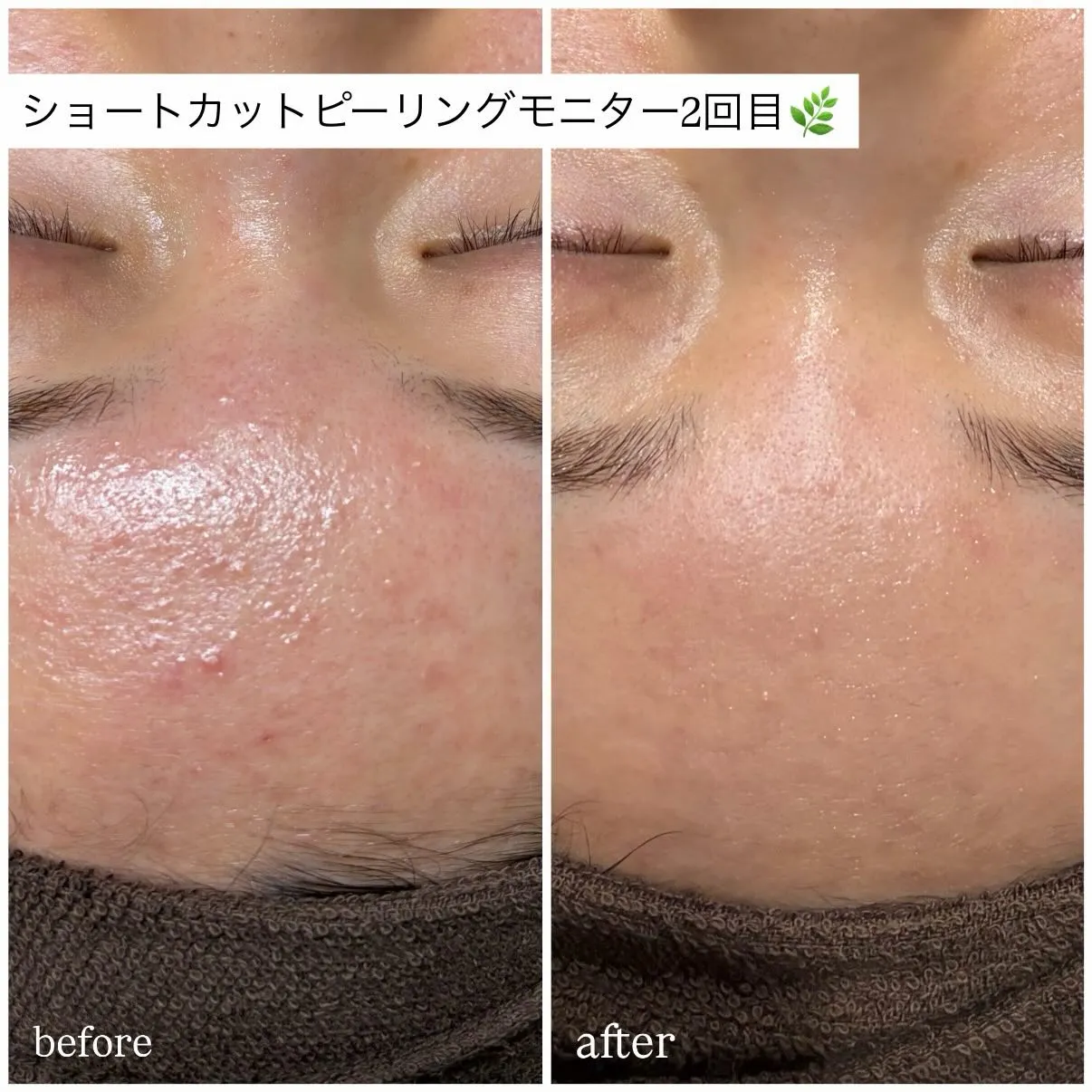 繰り返すニキビに悩んでいる方へ🌿