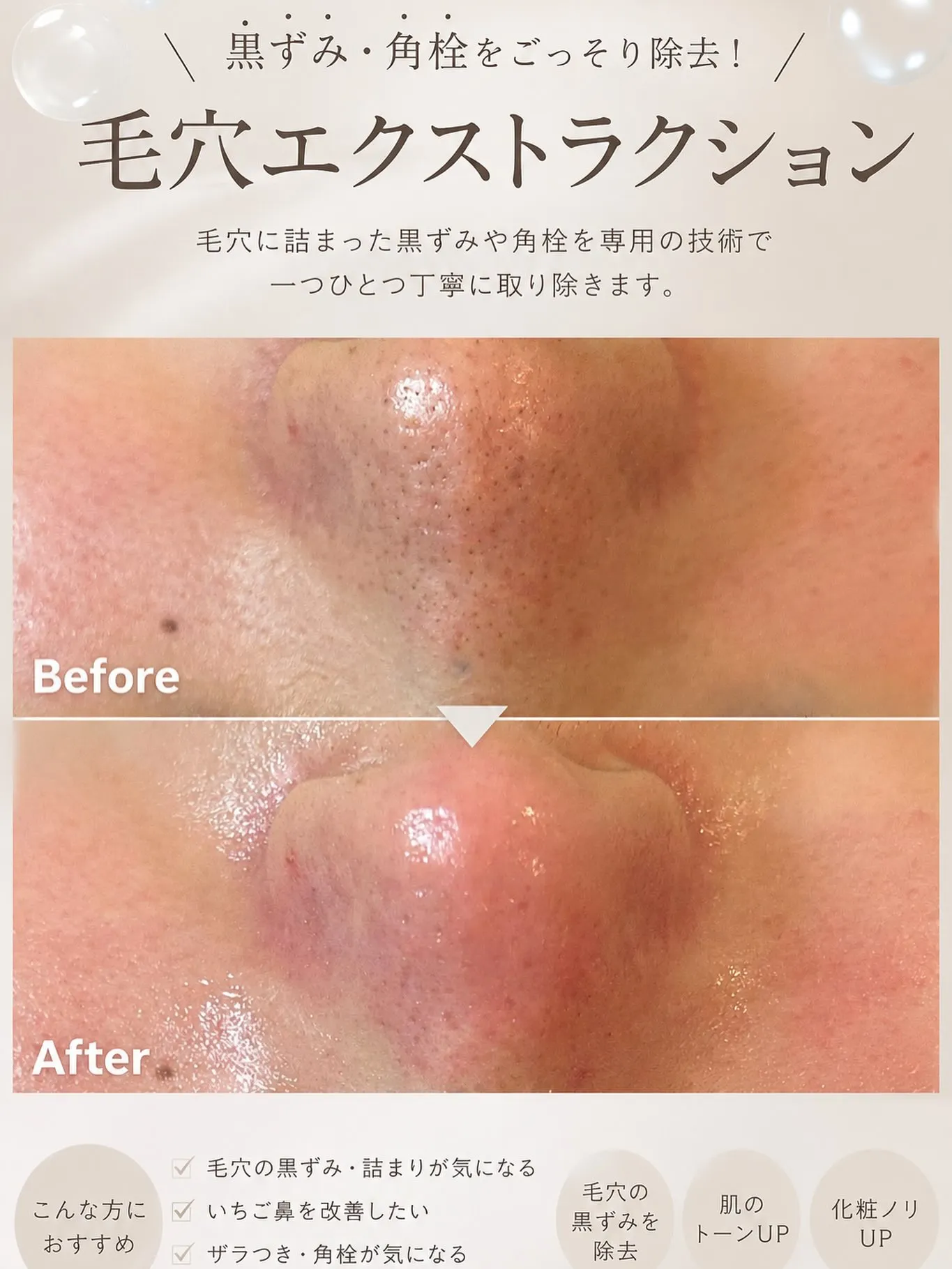 ＼黒ずみ・いちご鼻にお悩みの方必見👃🏻🫧／